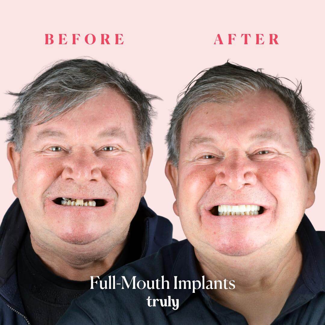 Before and after result 3