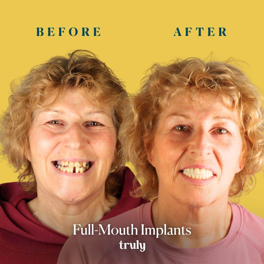 Before and after result 4