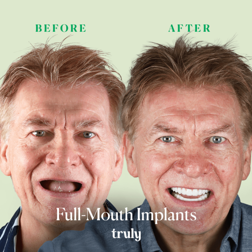 Implants