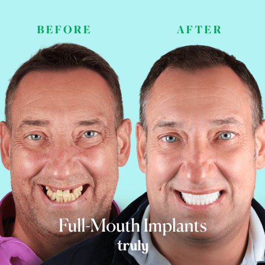 Implants