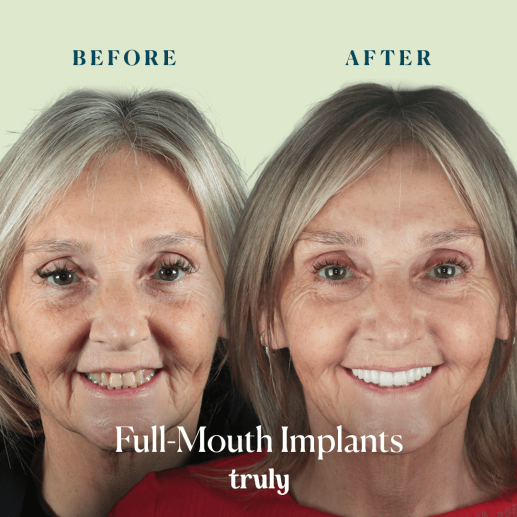 Implants
