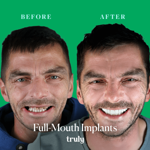 Implants