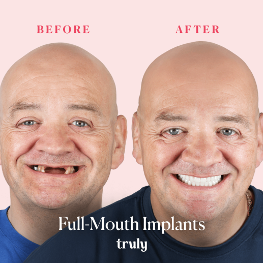 Implants