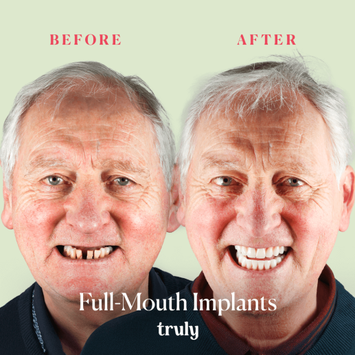 Implants
