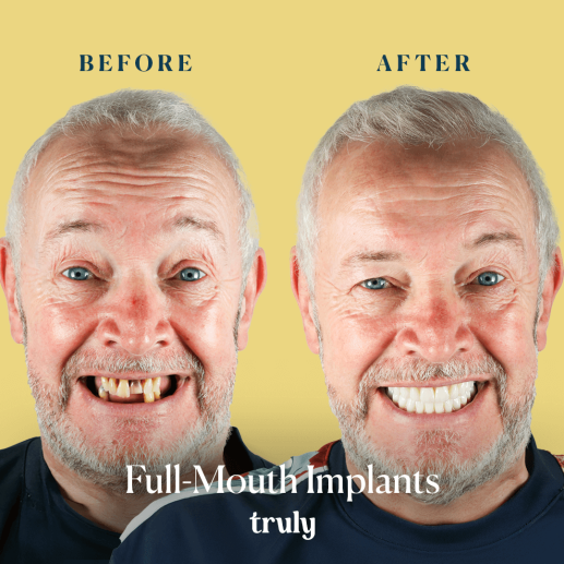 Implants