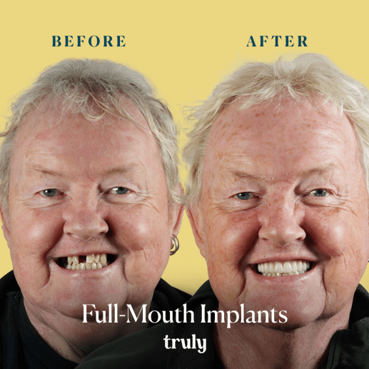Implants
