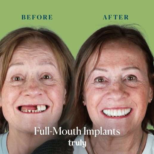 Implants