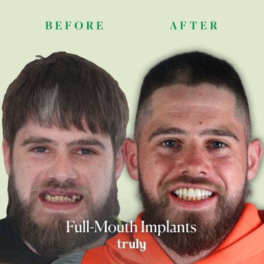 Implants