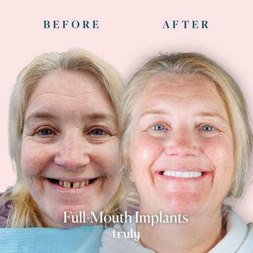 Implants