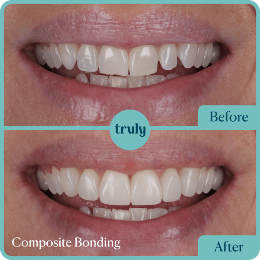 Composite Bonding
