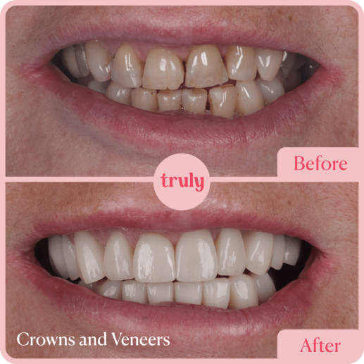 Crowns and Veneers