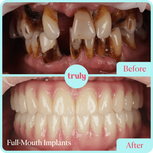 Implants