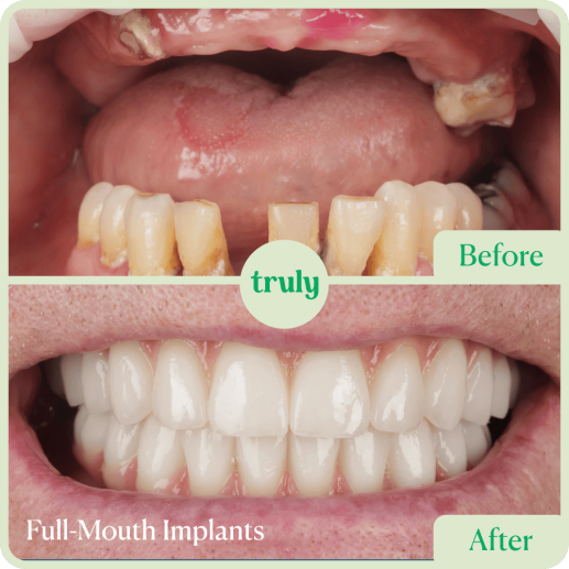 Implants