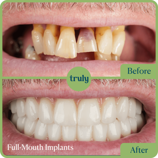 Implants