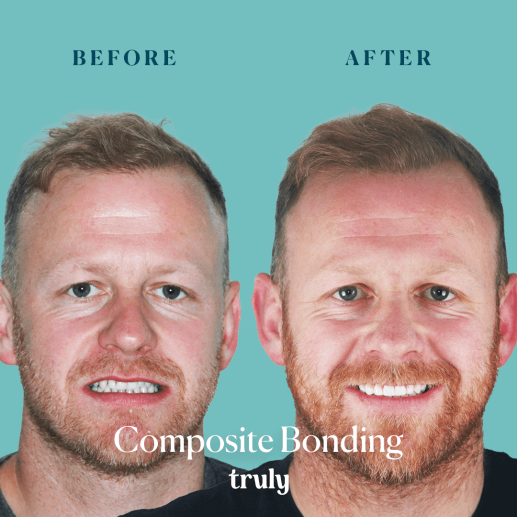 Composite bonding