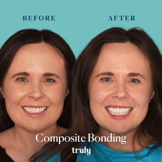 Composite bonding