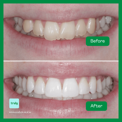 ABC ( Aligners, Bleaching, Composite )
