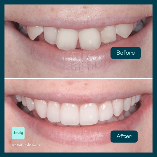 ABC ( Aligners, Bleaching, Composite )