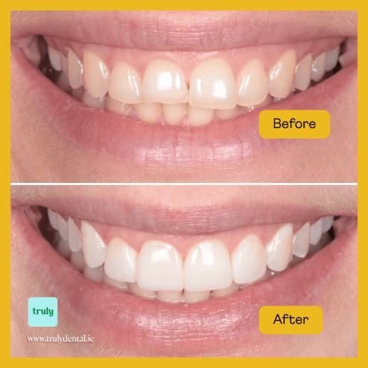 ABC ( Aligners, Bleaching, Composite )