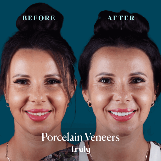 Porcelain Veneers