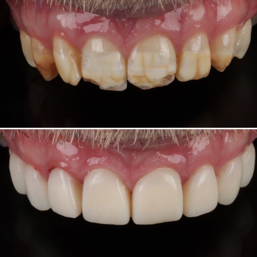 Veneers