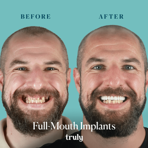 Implants