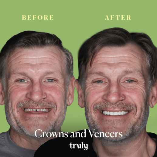 Crowns and Veneers