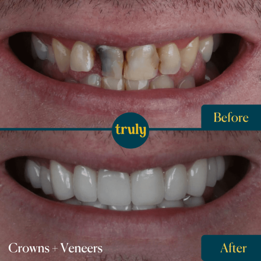 Crowns and Veneers