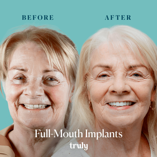 Implants